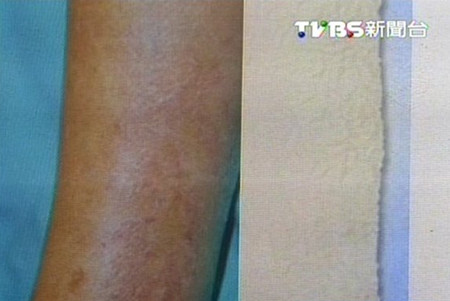 6歲女童頻繁用熱水洗手小手干皺如老婦(圖)