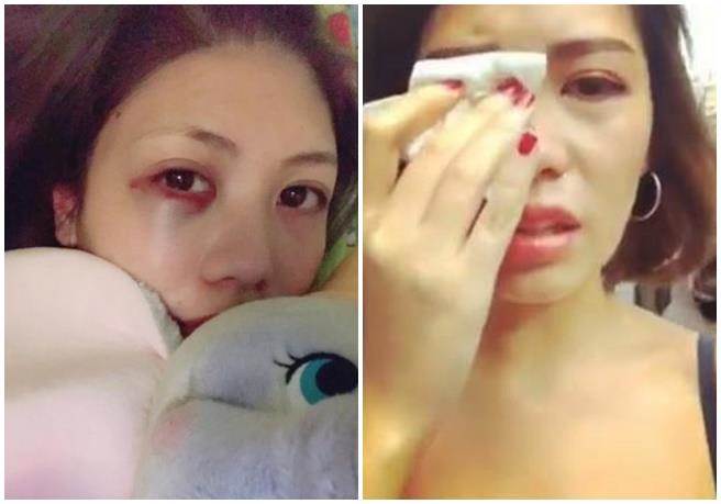 臺灣女子游紐約莫名被黑人打腫臉 怒批美:歧視王國 臺灣女子游紐約莫名被黑人打腫臉 怒批美:歧視王國