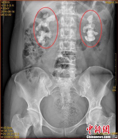 �Ĵ�һŮ�Ӻ���ˮ30�����p�I�L10���׾��ͽY(ji��)ʯ