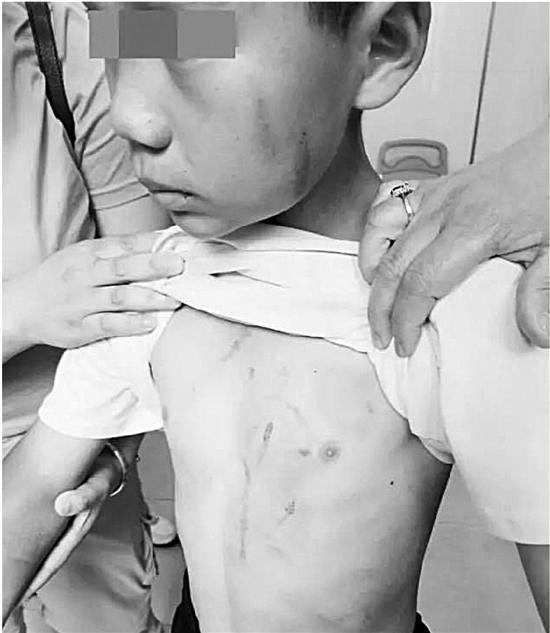 13歲的小男孩小靖(化名)身上都是傷痕。