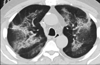 6�����S��CTƽ�߈D���@ʾë����Ӱ׃?y��u)錍׃���p�ȽY��Ť����(ͬһ����CTӰ��)