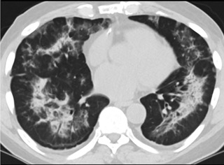 6�����S��CTƽ�߈D���@ʾë����Ӱ׃?y��u)錍׃���p�ȽY��Ť����(ͬһ����CTӰ��)